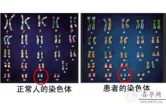 Y染色体缺失可以做第三代试管吗？附试管方案流