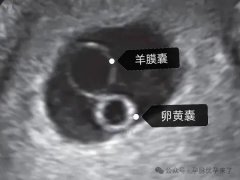 怀孕45天怀女孩的孕囊B超图片是怎么样的？