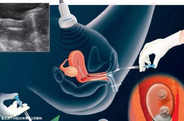 试管婴儿正常检查流程费用(试管婴儿检查全过程)