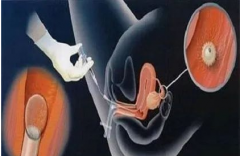 人工授精子女，法律上视同婚生子女